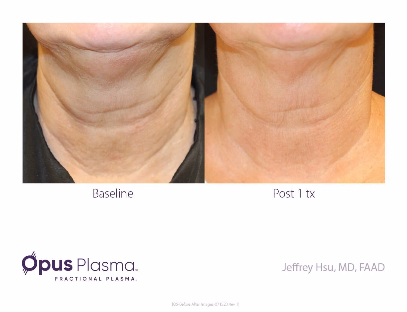 plasma skin tightening around the eyes in Ardsley, NY