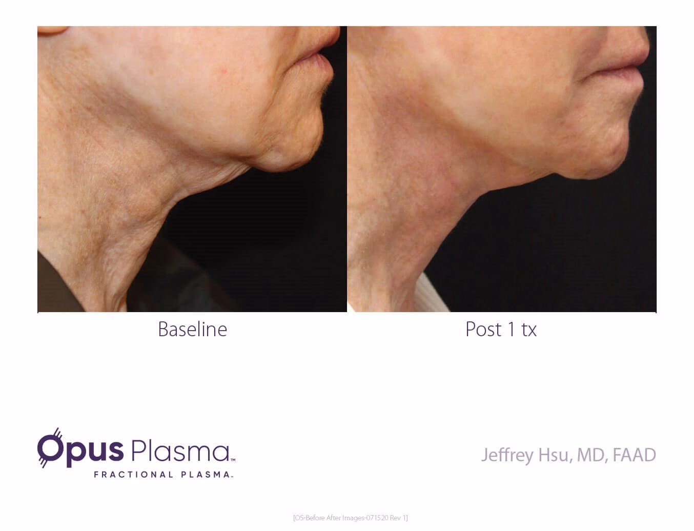 neck skin tightening in Ardsley, NY