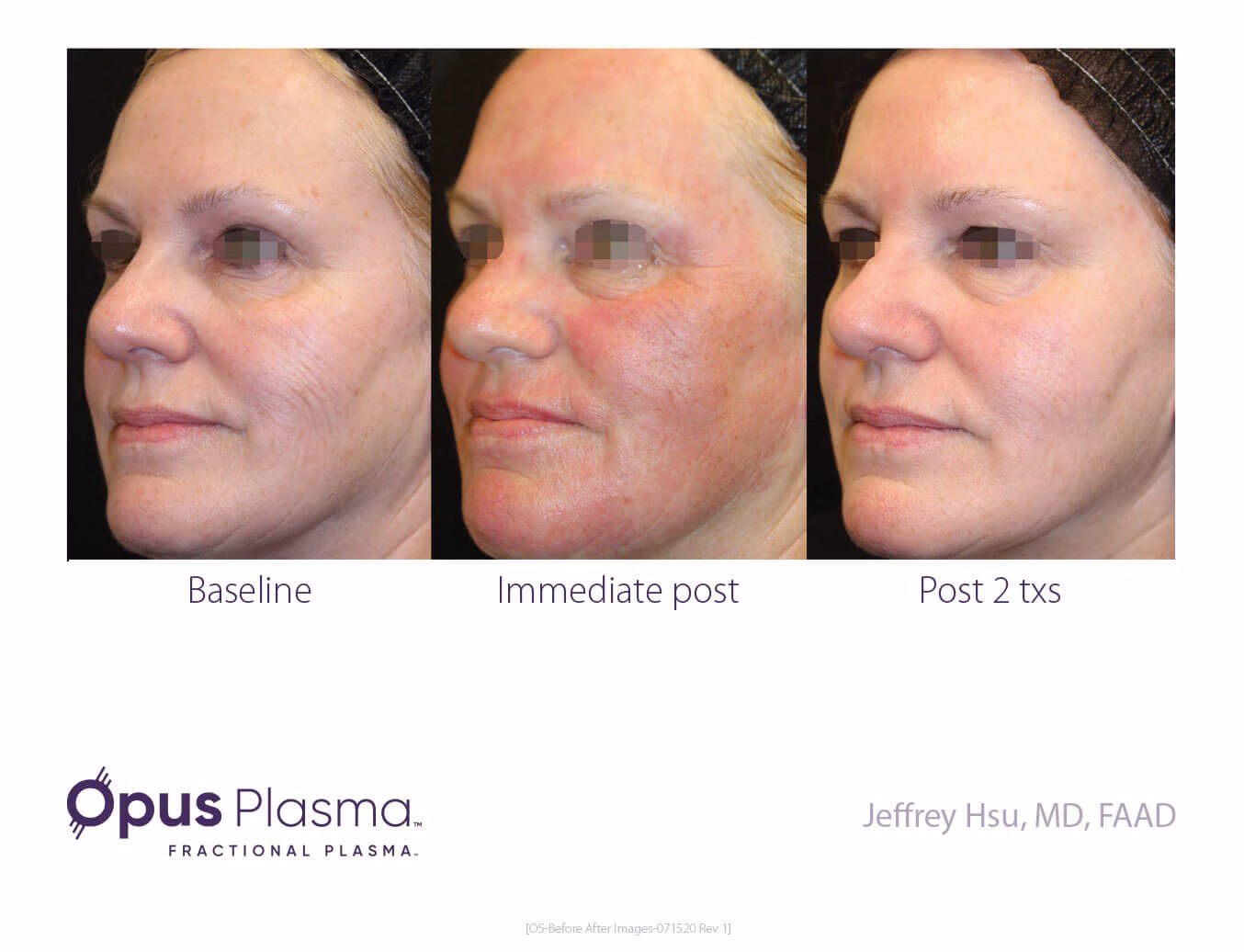 skin tightening around the mouth in Ardsley, NY