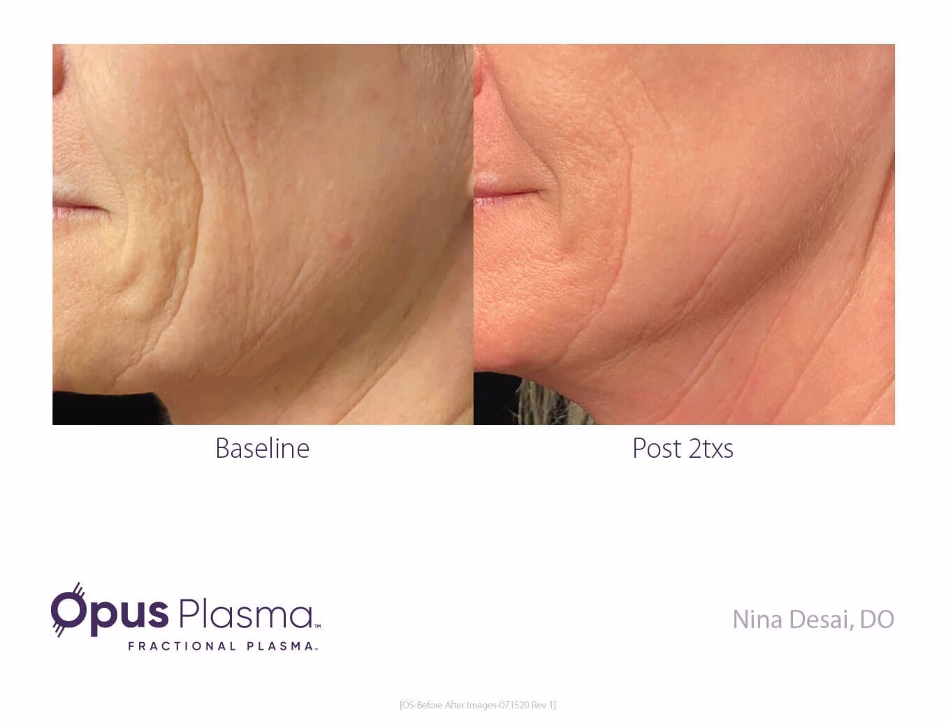 cheek skin tightening at Ardsley Dental Spa