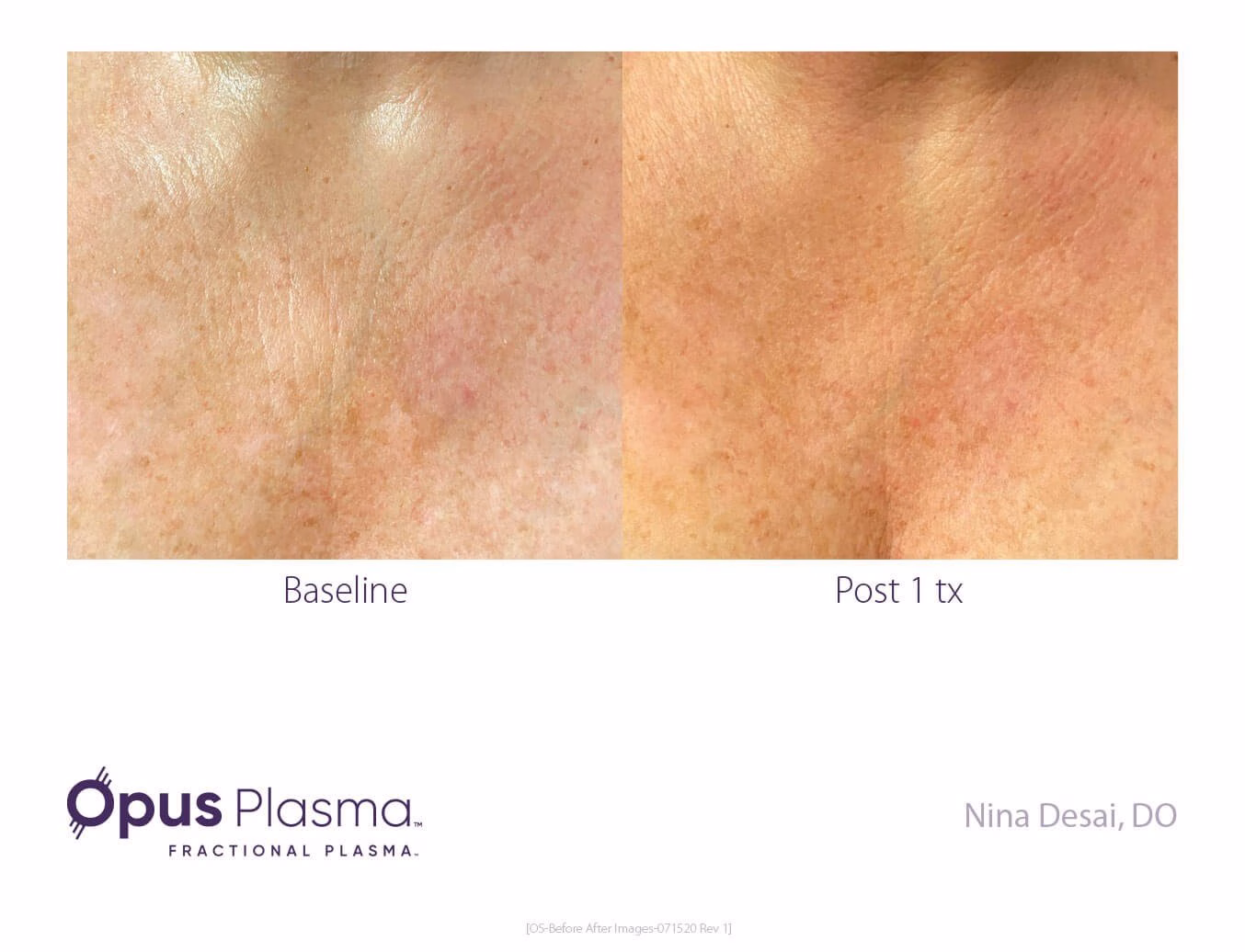 skin tightening results at Ardsley Dental Spa
