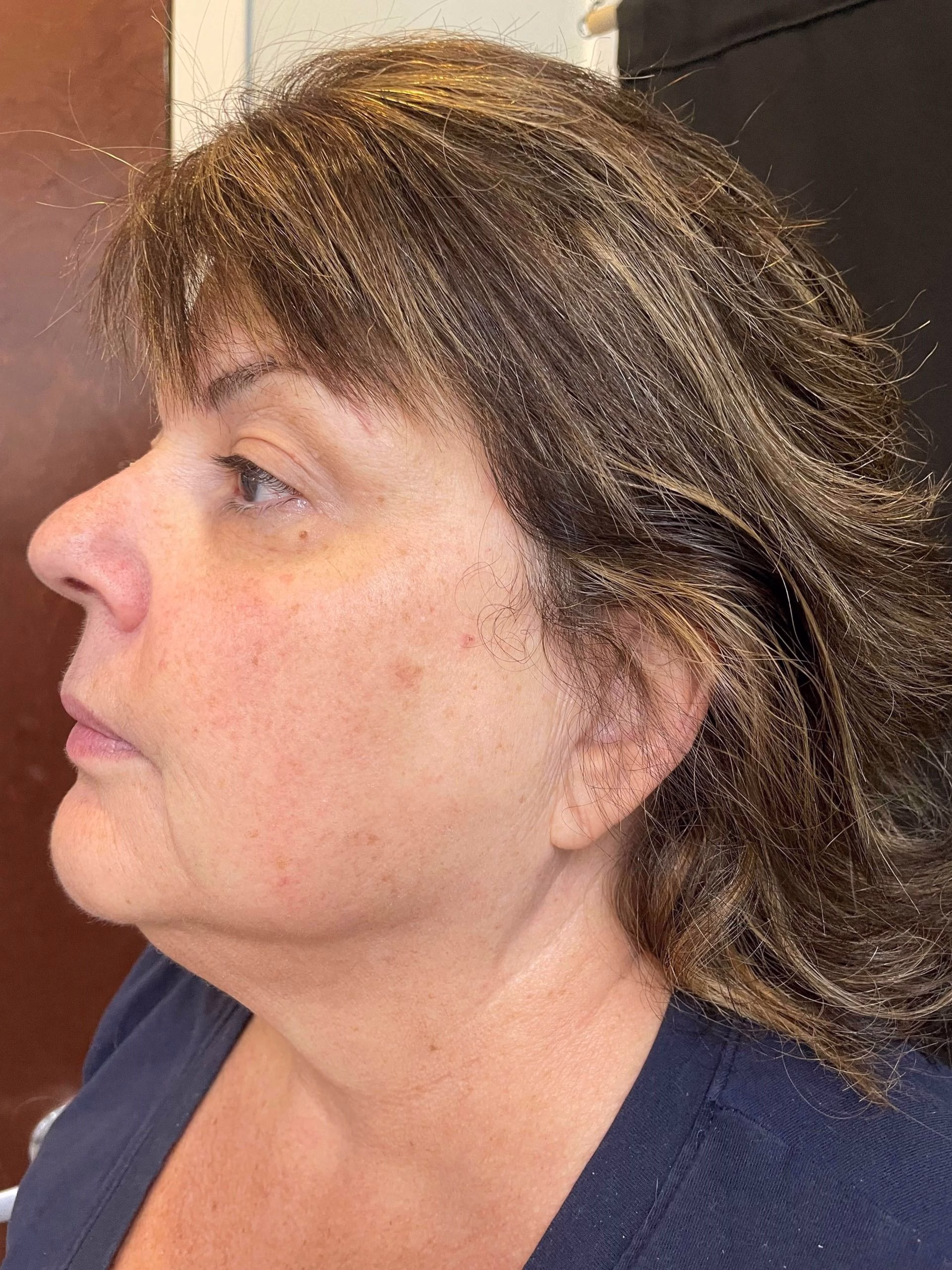 before Opus Plasma neck tightening in Ardsley, NY