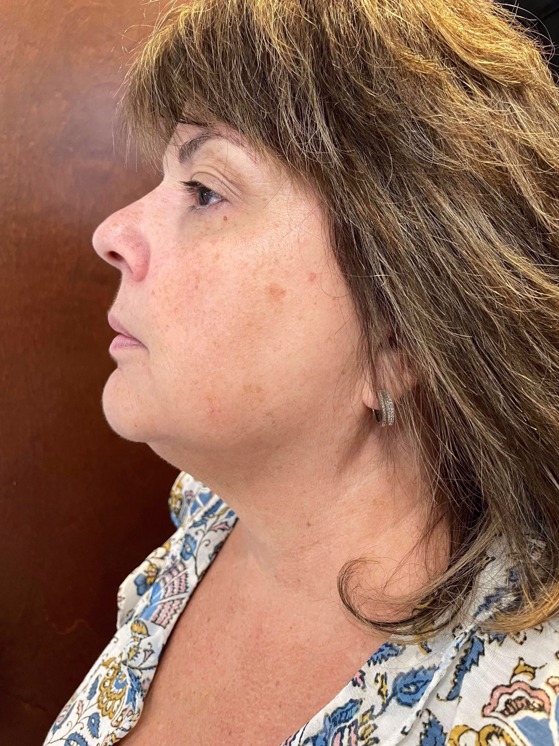 after Opus Plasma neck tightening in Ardsley, NY