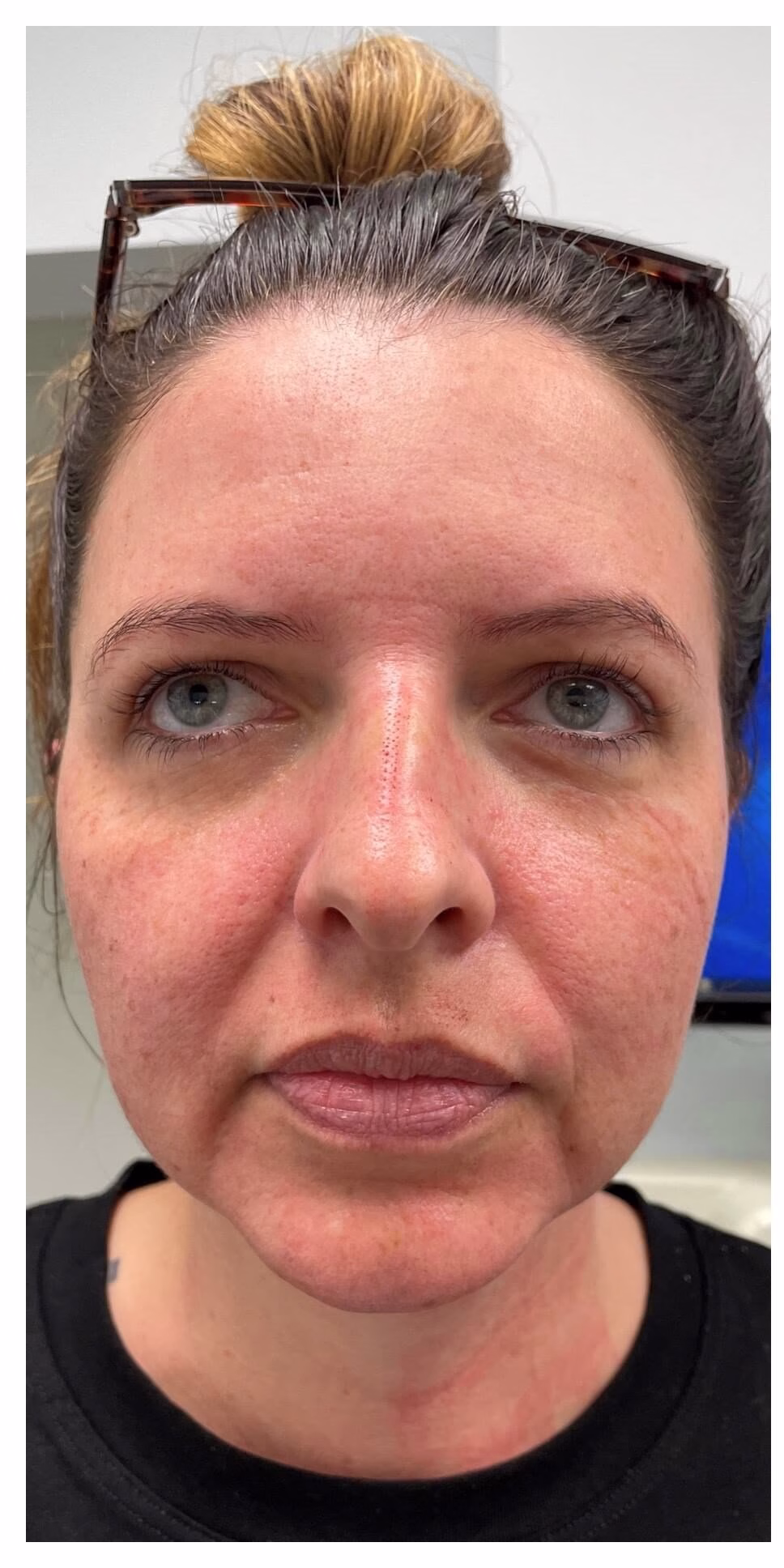before Opus Plasma treatment for redness in Ardsley, NY
