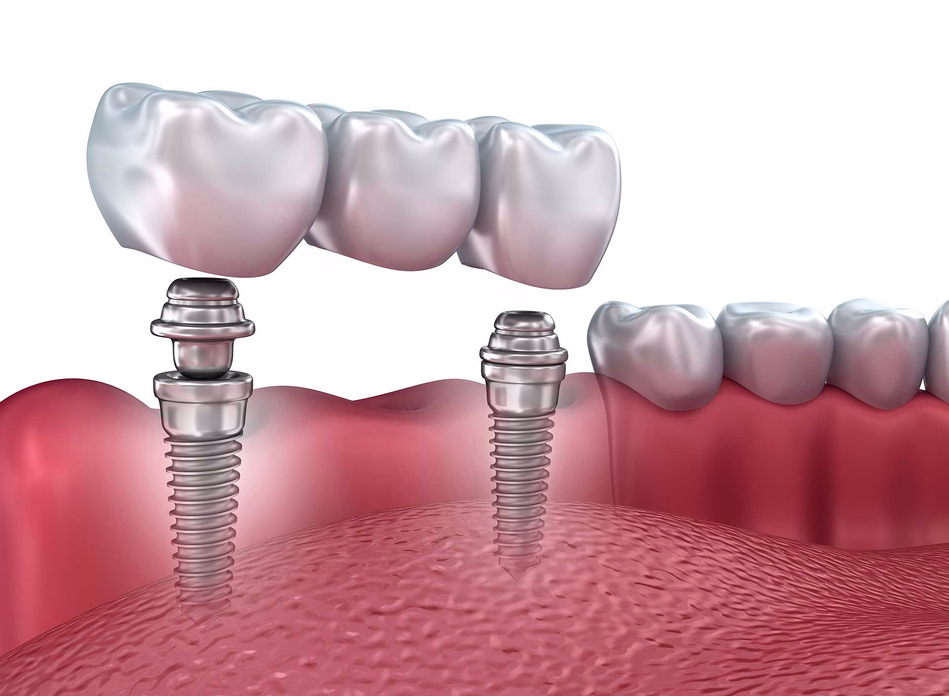 5 Ways Dental Implants Protect Your Oral Health - Dental Ardsley