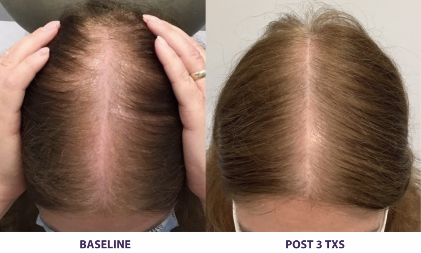 Alma TED hair thinning before and after