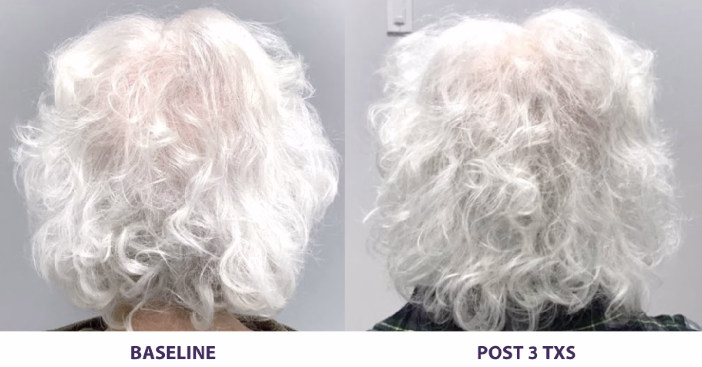 Alma TED hair restoration results at Ardsley Dental Spa