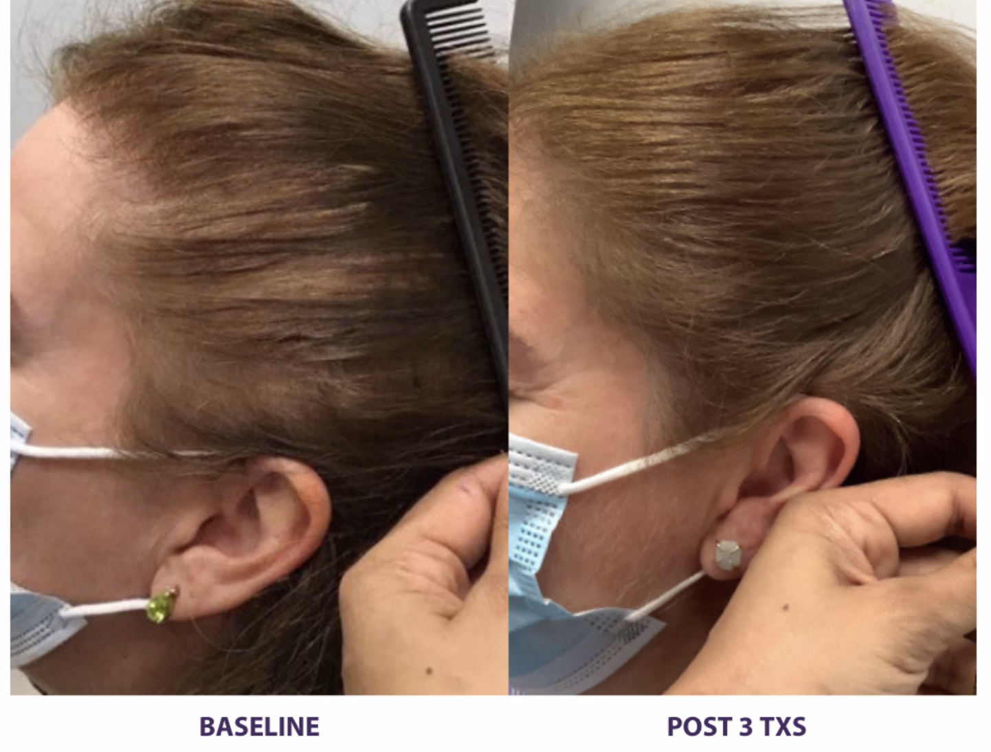 Alma TED fuller hair before and after