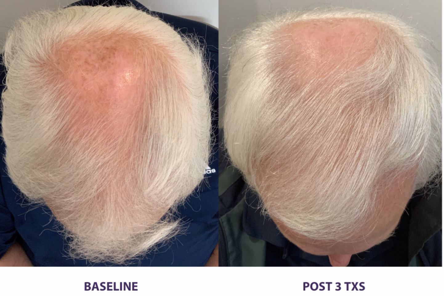 Alma TED non-surgical hair treatment results