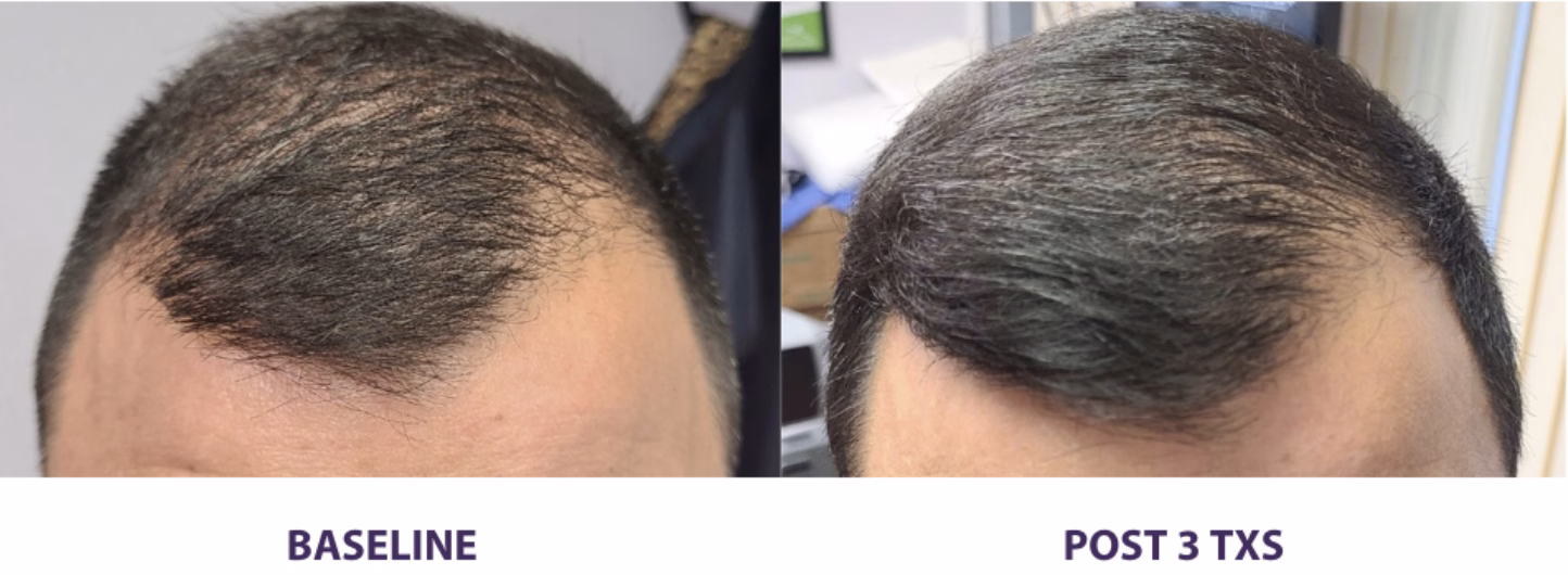 Alma TED before and after hair results in Ardsley, NY