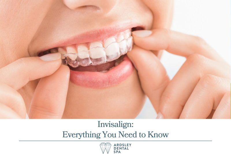 Invisalign Everything You Need to Know