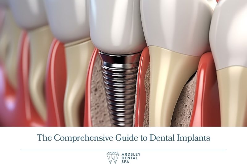 The Comprehensive Guide to Dental Implants