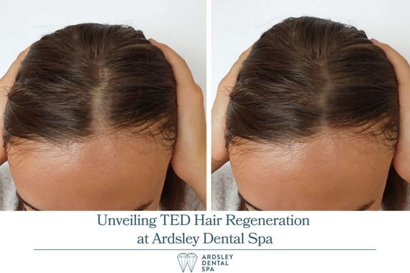 Unveiling TED Hair Regeneration at Ardsley Dental Spa
